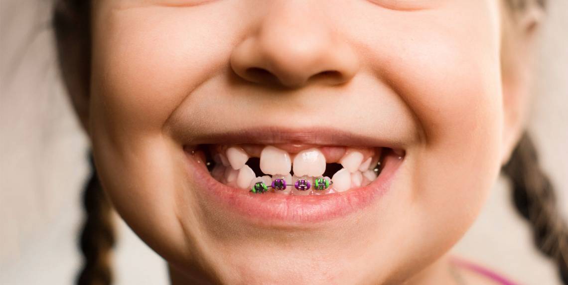 swissdent brackets niños