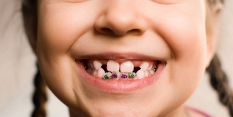 swissdent brackets niños