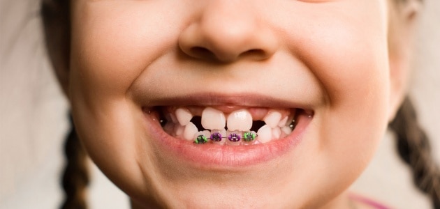 swissdent brackets niños