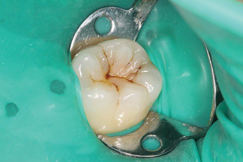 swissdent endodoncia dentista ica