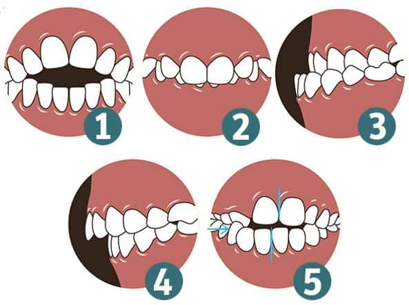 Brackets Swissdent Ica