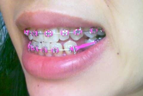 brackets ica extraccion