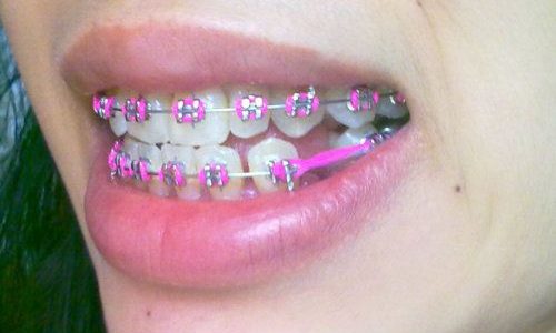brackets ica extraccion