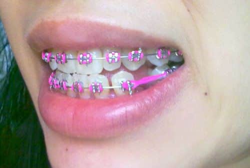 brackets ica extraccion