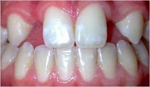 agenesia Swissdent