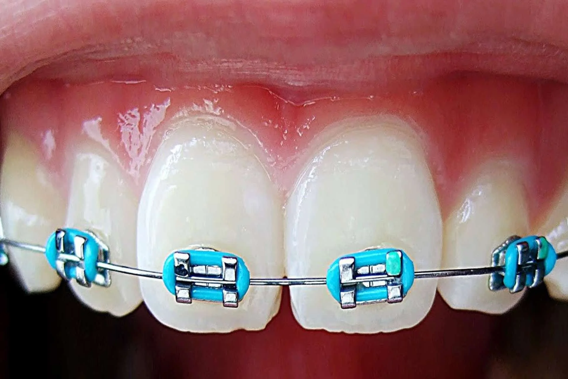 dentista ica brackets